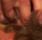 acupuncture treatment for neck pain