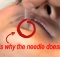 acupuncture needles don't hurt