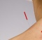 acupuncture can reverse nerve damage
