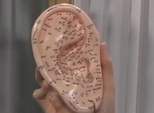 auricular acupuncture demonstration