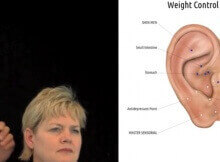 ear acupuncture for weight loss