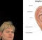 ear acupuncture for weight loss