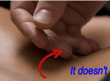 give acupunture a try
