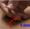 give acupunture a try