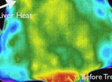acupuncture benefits shown by thermography