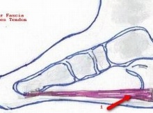 acpuncture treatment for plantar fasciitis