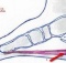 acpuncture treatment for plantar fasciitis
