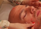 facial acupuncture demonstration