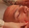 facial acupuncture demonstration